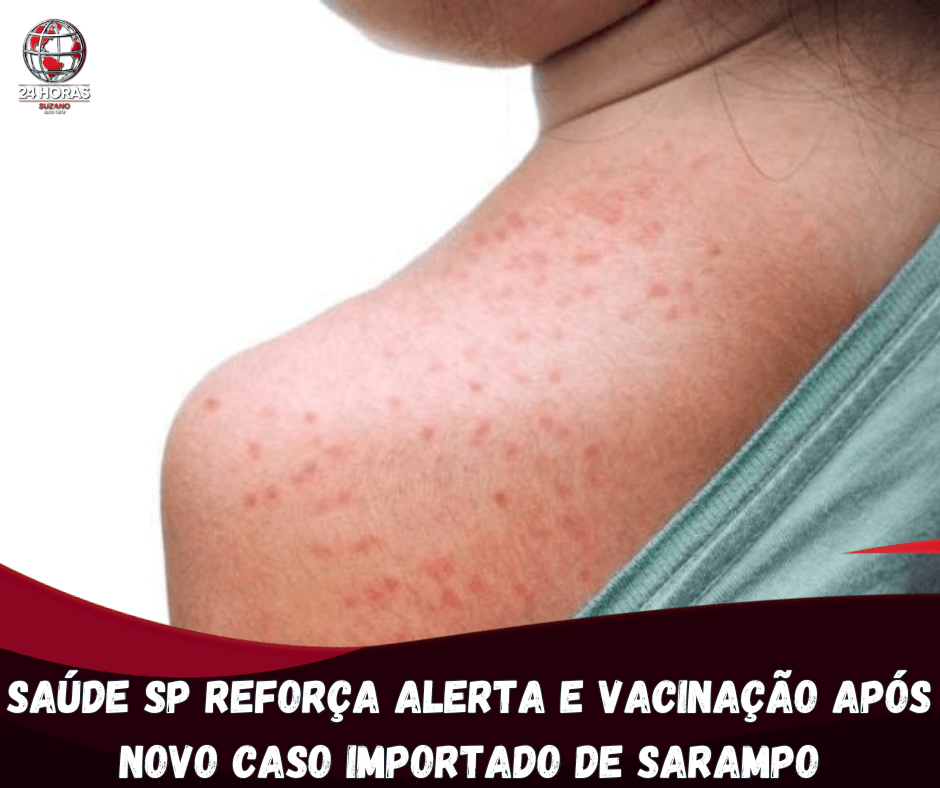 Saúde de SP reforça alerta e intensifica vacinação após novo caso importado de sarampo